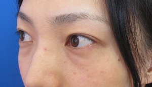 目の下のたるみ、目のくまでお悩みの方、切らずに完璧に解決します。TCB-R法　手術直後　症例写真
